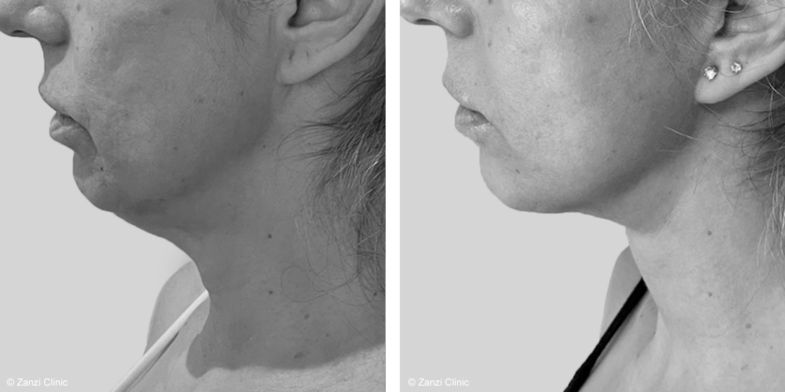 Photos avant/après un lifting du cou: dites adieu au double menton à la Zanzi Clinic.