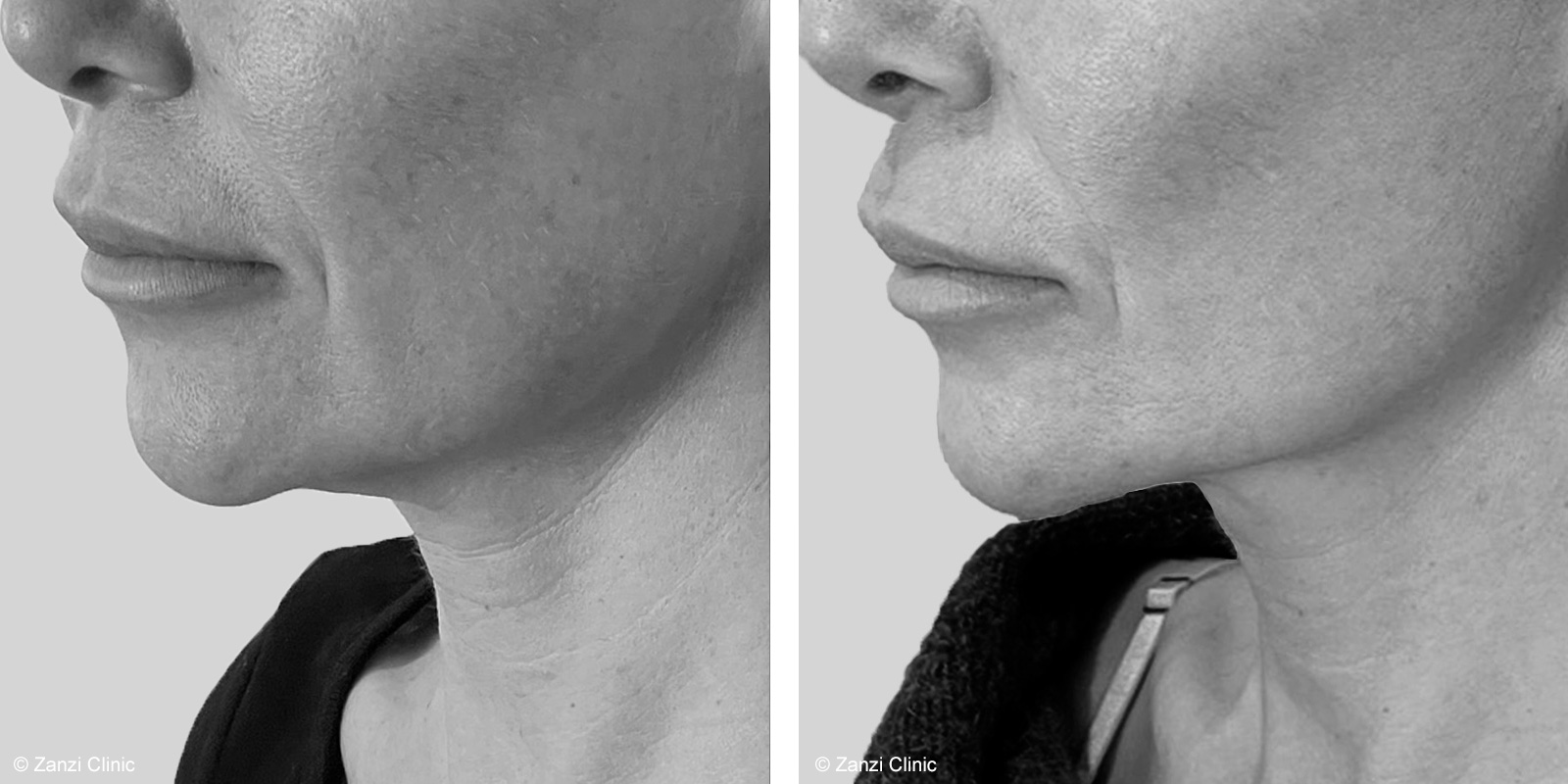 Photos avant après lifting du cou à la Zanzi Clinic : la peau est retendue, les contours sont affinés.