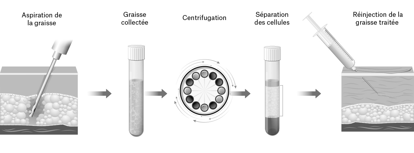 Schéma du traitement de la graisse lors d'un lipofilling