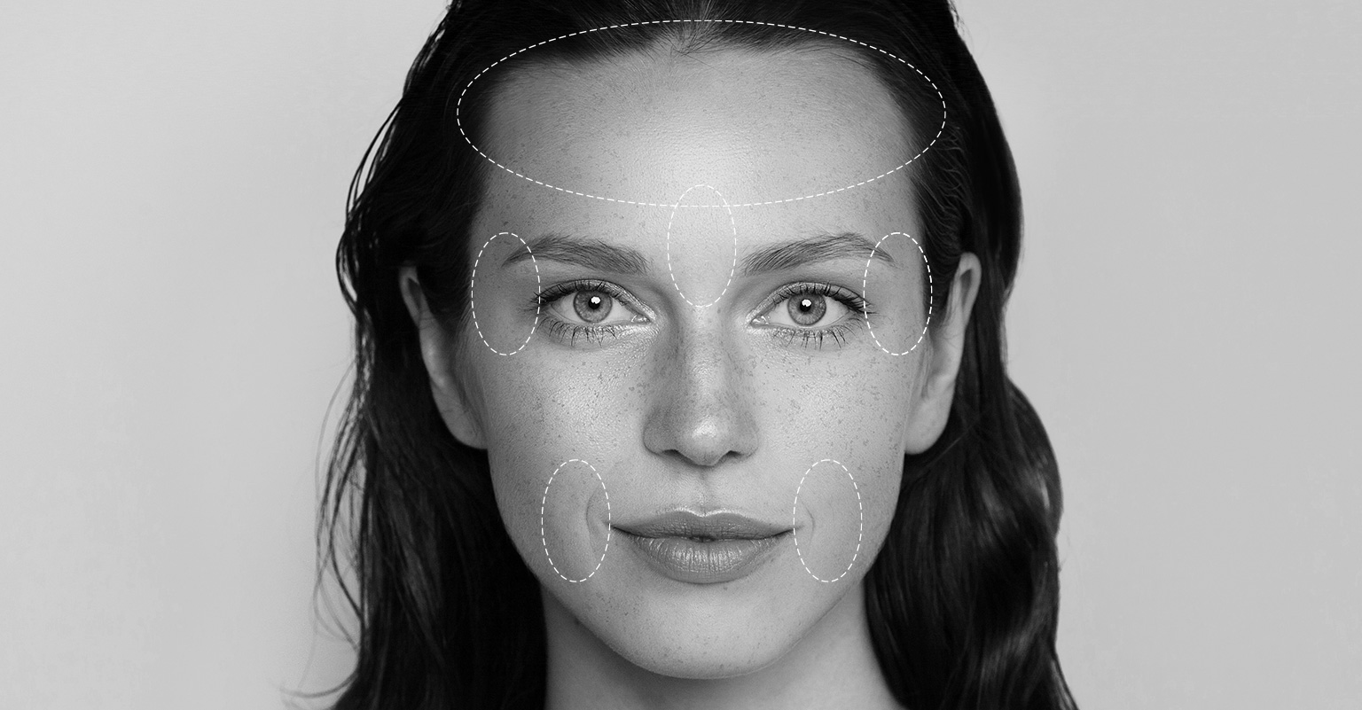 Schéma des zones traitées par le Botox®: front, rides du lion, pattes d’oie.