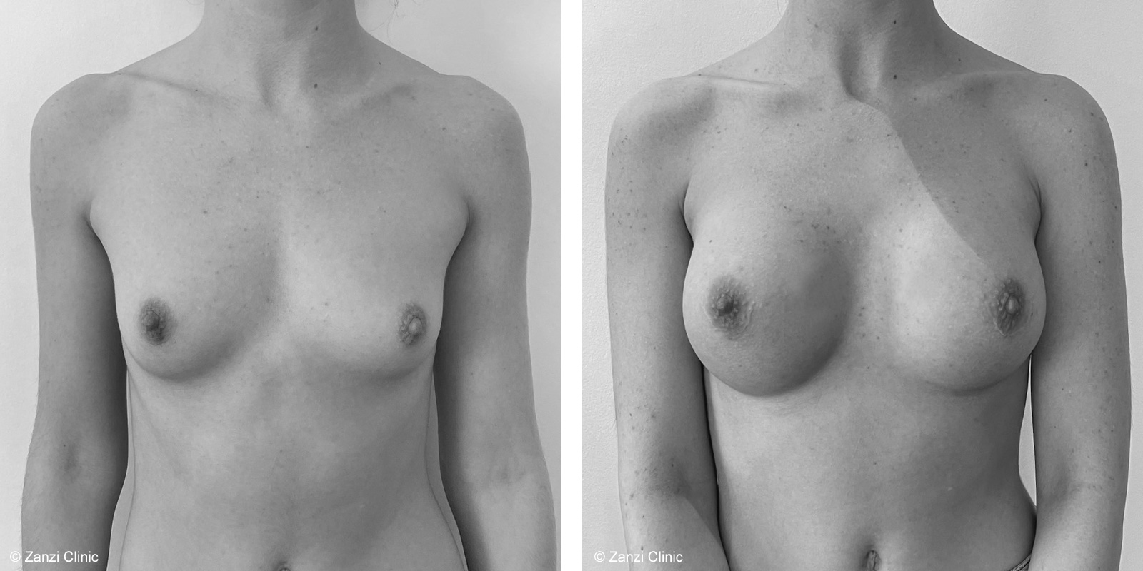 Avant/Après implants mammaires