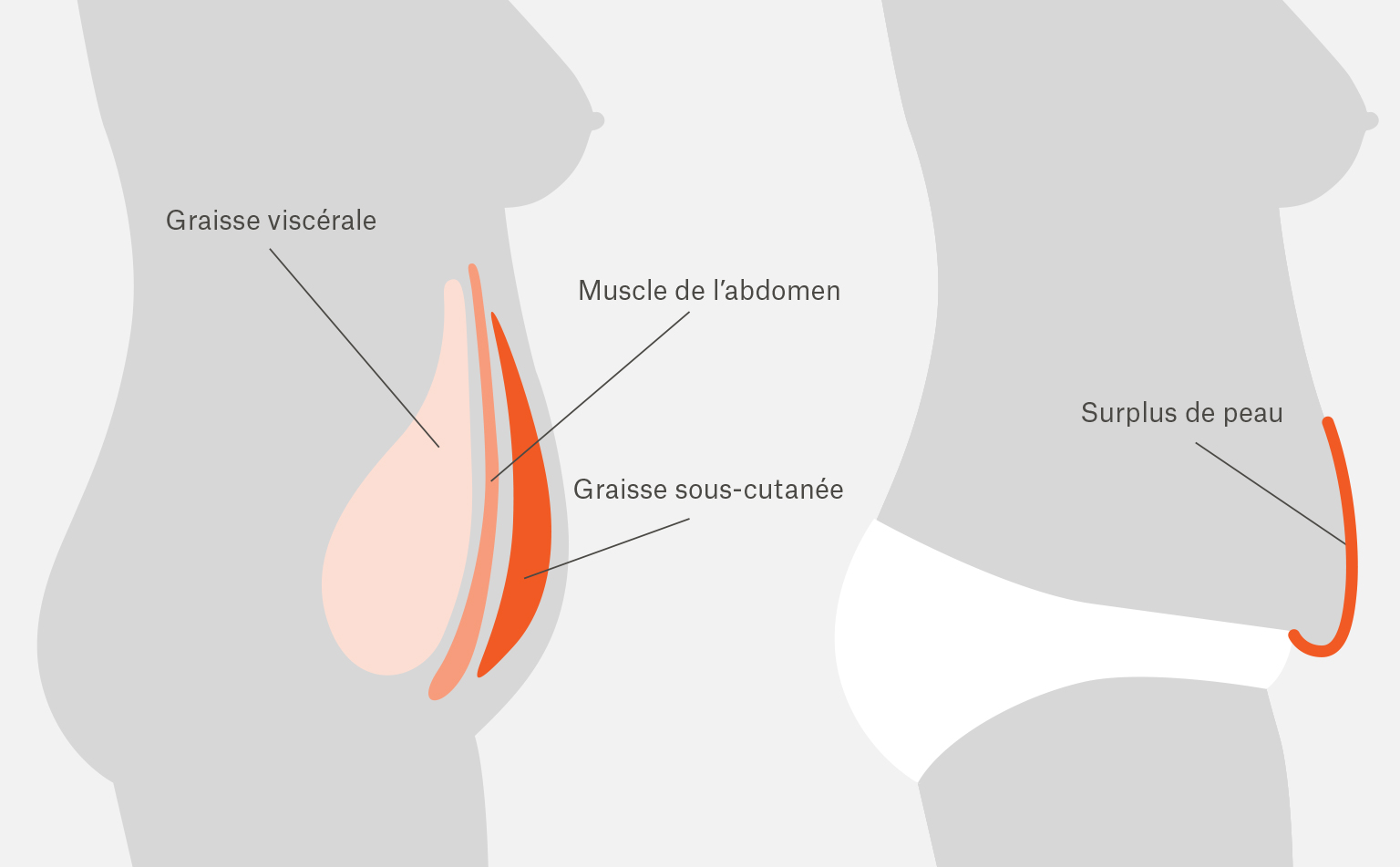 Schéma des différents pans qui constituent la paroi abdominale et qui sont au coeur d’une intervention de chirurgie esthétique pour un ventre plat.