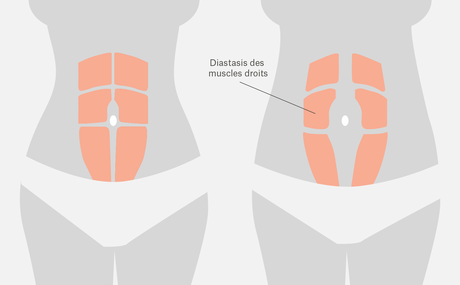 Diastasis des muscles droits ©Zanzi Clinic