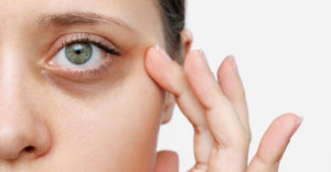 Les cernes apparaissent lorsque la peau se colore