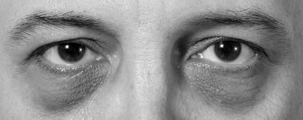 Les cernes bruns sont liés à une hyperpigmentation mélanique de la peau