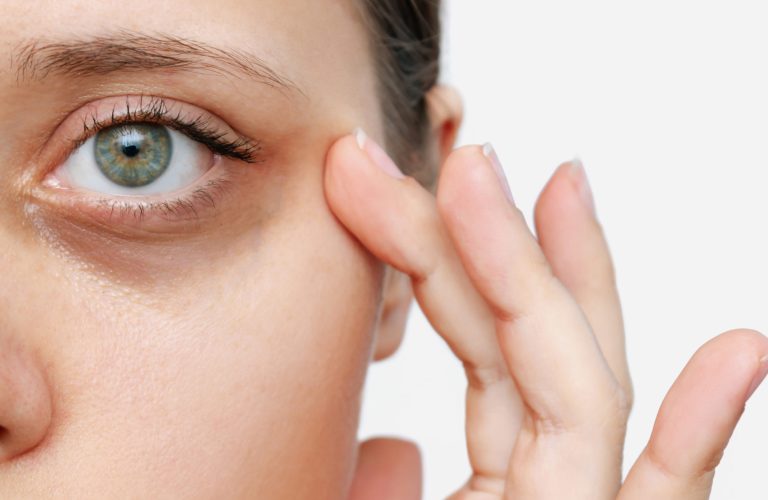 Les cernes apparaissent lorsque la peau se colore